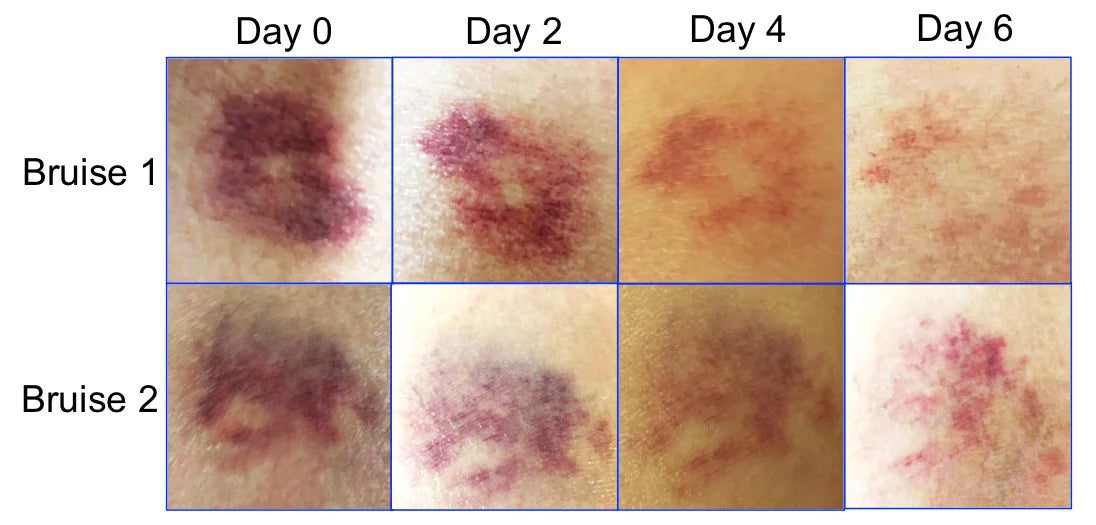 CREAM, BruiseGONE Natural remedy NO ONE bruise WEEK, healing Speeds bruise by 3 pack-